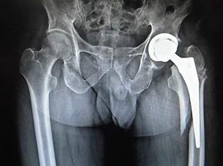 ISO 7206: Hip Joint Prosthesis Testing